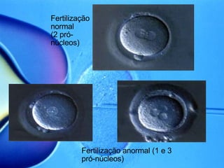 Fertilização normal (2 pró-núcleos)‏ Fertilização anormal (1 e 3 pró-núcleos)‏ 