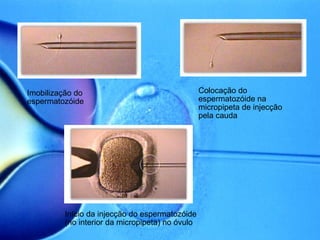Imobilização do espermatozóide   Colocação do espermatozóide na micropipeta de injecção pela cauda  Início da injecção do espermatozóide (no interior da micropipeta) no óvulo  