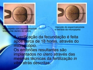 Micropipeta com espermatozóide totalmente dentro do oócito    Injecção do espermatozóide e retirada da micropipeta   A verificação da fecundação é feita após cerca de 18 horas, através do microscópio.  Os embriões resultantes são implantados no útero através das mesmas técnicas da fertilização  in vitro  atrás descritas. 
