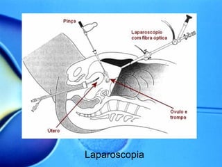 Laparoscopia 