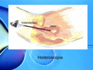 Histeroscopia 