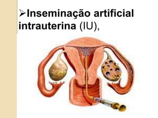 Inseminação artificial
intrauterina (IU),
 