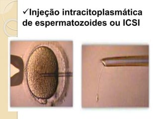 Injeção intracitoplasmática
de espermatozoides ou ICSI
 