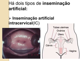 Há dois tipos de inseminação
artificial:
 Inseminação artificial
intracervical(IC)
 