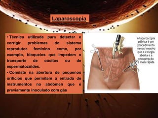 Laparoscopia 
• Técnica utilizada para detectar e 
corrigir problemas do sistema 
reprodutor feminino como, por 
exemplo, bloqueios que impedem o 
transporte de oócitos ou de 
espermatozóides. 
• Consiste na abertura de pequenos 
orifícios que permitem a entrada de 
instrumentos no abdómen que é 
previamente inoculado com gás 
 