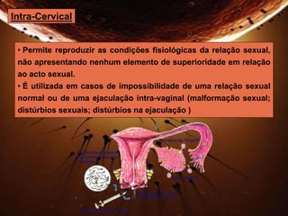 Intra-Cervical 
• Permite reproduzir as condições fisiológicas da relação sexual, 
não apresentando nenhum elemento de superioridade em relação 
ao acto sexual. 
• É utilizada em casos de impossibilidade de uma relação sexual 
normal ou de uma ejaculação intra-vaginal (malformação sexual; 
distúrbios sexuais; distúrbios na ejaculação ) 
 