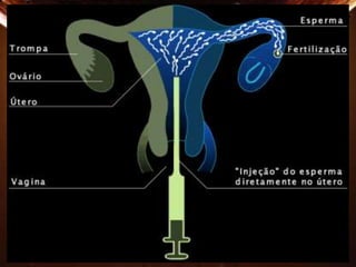 Imagem esquemática da Inseminação Artificial Intra-Uterina (IU) 
 