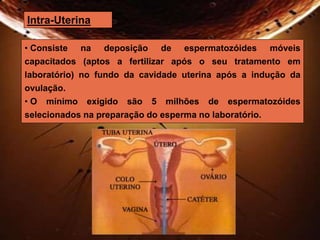 Intra-Uterina 
• Consiste na deposição de espermatozóides móveis 
capacitados (aptos a fertilizar após o seu tratamento em 
laboratório) no fundo da cavidade uterina após a indução da 
ovulação. 
• O mínimo exigido são 5 milhões de espermatozóides 
selecionados na preparação do esperma no laboratório. 
 
