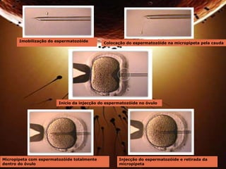 Imobilização do espermatozóide 
Colocação do espermatozóide na micropipeta pela cauda 
Inicio da injecção do espermatozóide no óvulo 
Micropipeta com espermatozóide totalmente 
dentro do óvulo 
Injecção do espermatozóide e retirada da 
micropipeta 
 