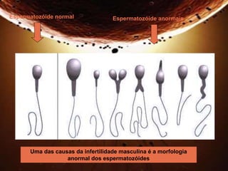 Espermatozóide normal Espermatozóide anormais 
Uma das causas da infertilidade masculina é a morfologia 
anormal dos espermatozóides 
 