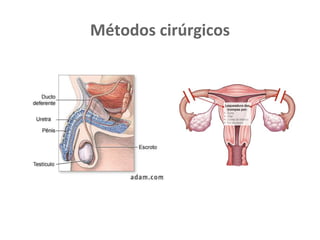 Métodos cirúrgicos
 