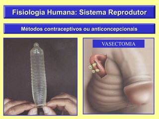Fisiologia Humana: Sistema Reprodutor
Métodos contraceptivos ou anticoncepcionais
VASECTOMIA
 
