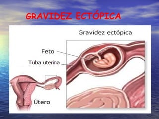 GR AVIDEZ ECTÓPICA 