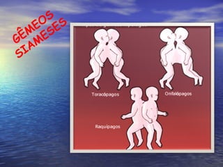 GÊMEOS   SIAMESES 