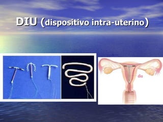 DIU  ( dispositivo intra-uterino ) 