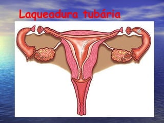 Laqueadura tubária 