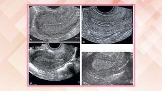Imaging of female reproductive system RV | PPTX