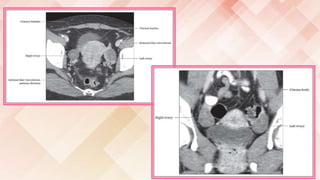 Imaging of female reproductive system RV | PPTX