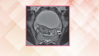 Imaging of female reproductive system RV | PPTX