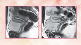 Imaging of female reproductive system RV | PPTX