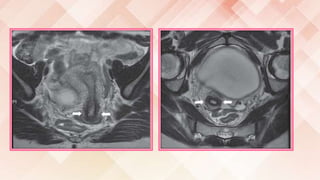 Imaging of female reproductive system RV | PPTX