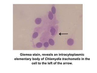Giemsa stain, reveals an intracytoplasmic
elementary body of Chlamydia trachomatis in the
cell to the left of the arrow.
 