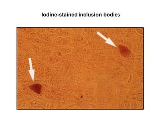 Iodine-stained inclusion bodies
 