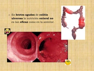 o En brotes agudos de colitis
  ulcerosa la nutrición enteral no
  es tan eficaz como en la anterior.
 