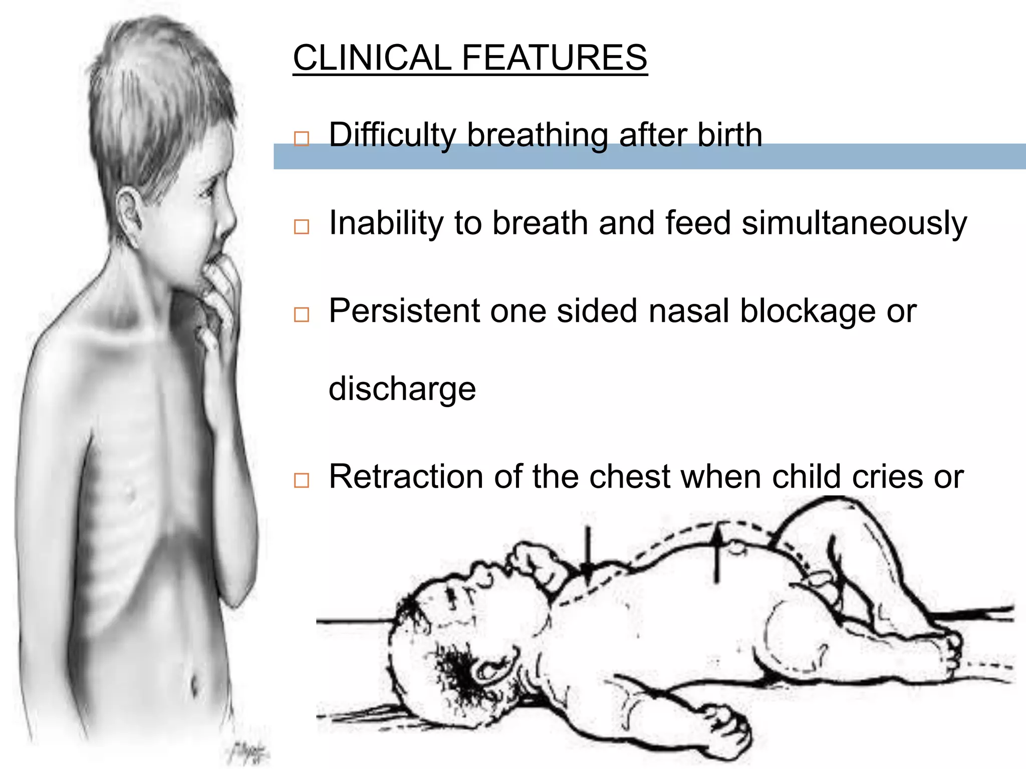 RESPIRATORY DISORDERS IN CHILDREN
