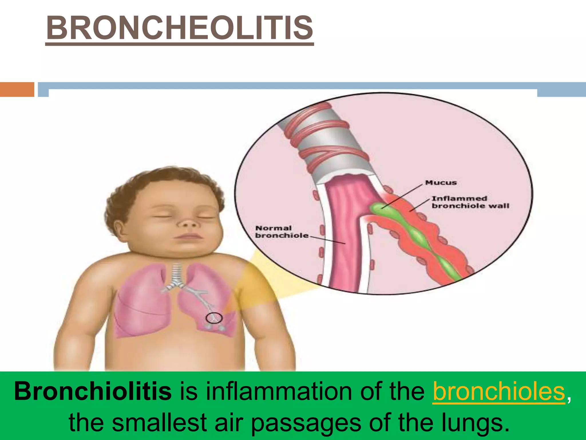 RESPIRATORY DISORDERS IN CHILDREN