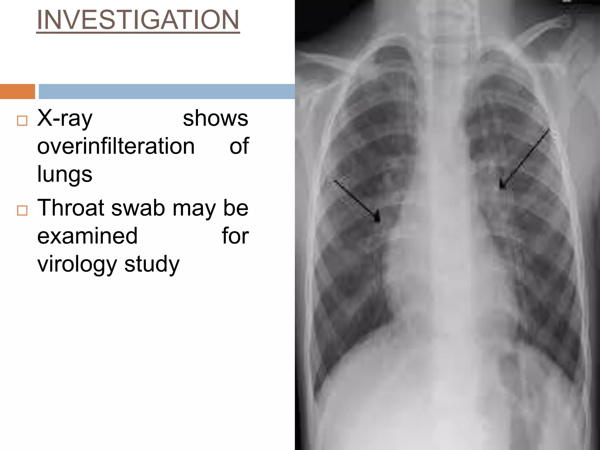 RESPIRATORY DISORDERS IN CHILDREN