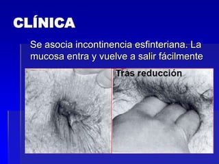 CLÍNICA
Se asocia incontinencia esfinteriana. La
mucosa entra y vuelve a salir fácilmente

 