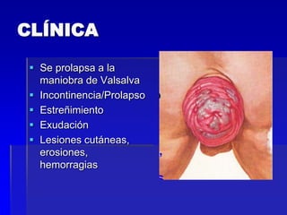 CLÍNICA
 Se prolapsa a la
maniobra de Valsalva
 Incontinencia/Prolapso
 Estreñimiento
 Exudación
 Lesiones cutáneas,
erosiones,
hemorragias

 