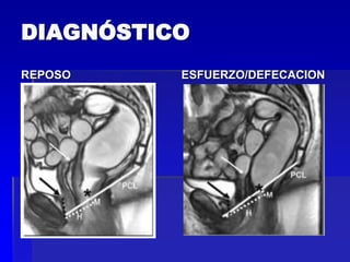 DIAGNÓSTICO
REPOSO

ESFUERZO/DEFECACION

 