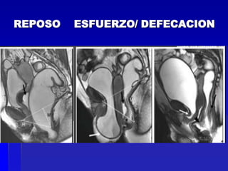 REPOSO

ESFUERZO/ DEFECACION

 