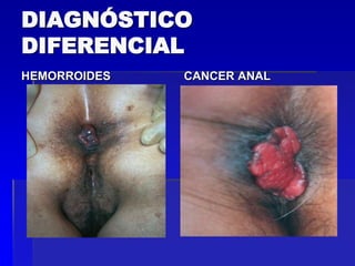 DIAGNÓSTICO
DIFERENCIAL
HEMORROIDES

CANCER ANAL

 