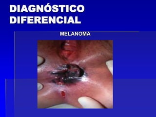 DIAGNÓSTICO
DIFERENCIAL
MELANOMA

 