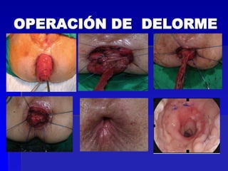 OPERACIÓN DE DELORME

 