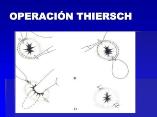 OPERACIÓN THIERSCH

 