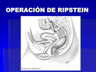 OPERACIÓN DE RIPSTEIN

 