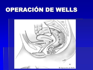 OPERACIÓN DE WELLS

 