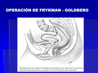 OPERACIÓN DE FRYKMAN - GOLDBERG

 