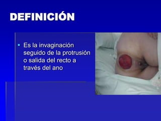 DEFINICIÓN
 Es la invaginación
seguido de la protrusión
o salida del recto a
través del ano

 