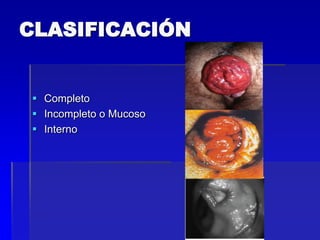 CLASIFICACIÓN

 Completo
 Incompleto o Mucoso
 Interno

 