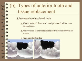 (b) Types of anterior tooth and
tissue replacement
3 Processed tooth-colored resin
a Waxed to metal framework and processed with tooth-
colored resin
b May be used when undesirable soft tissue undercuts are
present
c Requires stable ridge
 