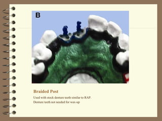 Braided Post
Used with stock denture teeth similar to RAP.
Denture teeth not needed for wax-up
 