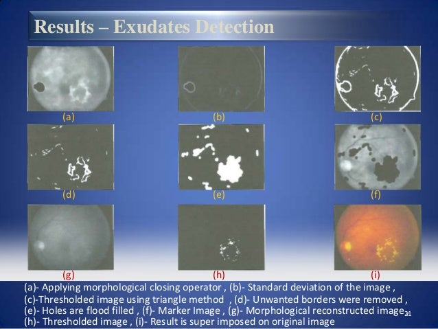 Undergraduate student thesis exudate detection retinal images