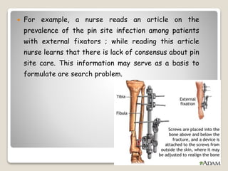  For example, a nurse reads an article on the
prevalence of the pin site infection among patients
with external fixators ; while reading this article
nurse learns that there is lack of consensus about pin
site care. This information may serve as a basis to
formulate are search problem.
 
