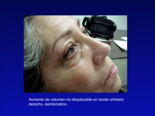 Aumento de volumen no desplazable en borde orbitario
derecho, asintomático.
 