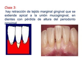 Clase 3:
hay retracción de tejido marginal gingival que se
extiende apical a la unión mucogingival, en
dientes con pérdida de altura del periodonto
proximal.

 